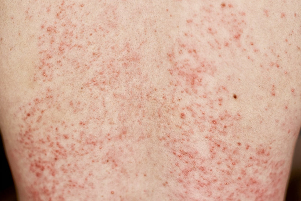 Qu'est-ce que la dermatite atopique ?