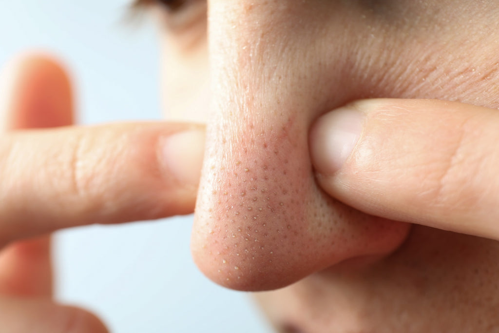 Points noirs : pourquoi ne pas les percer ?