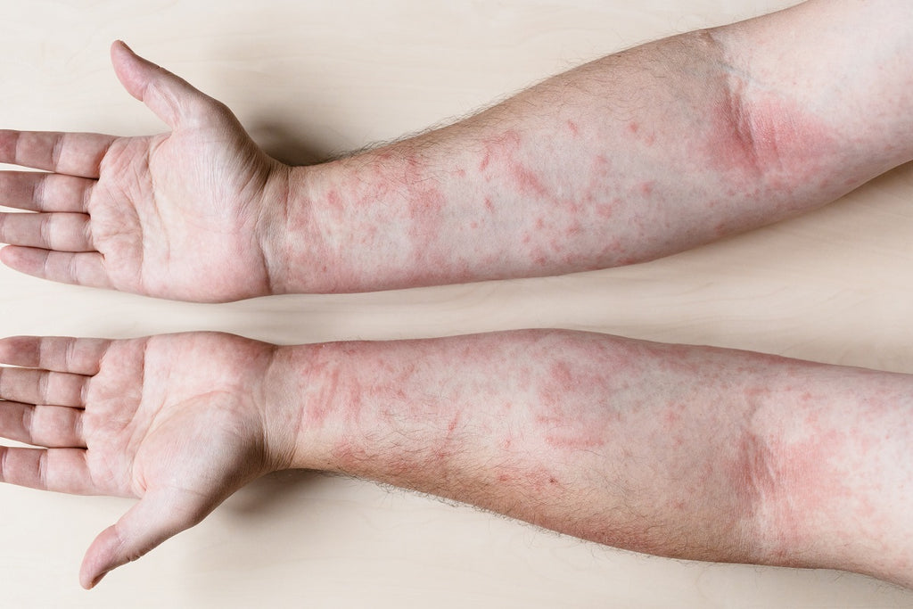 Dermatite de contact et ses causes