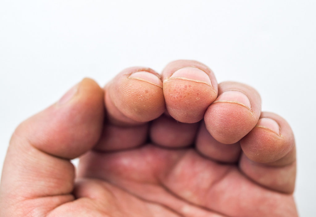 Pourquoi la peau des doigts pèle ou s'épluche ?